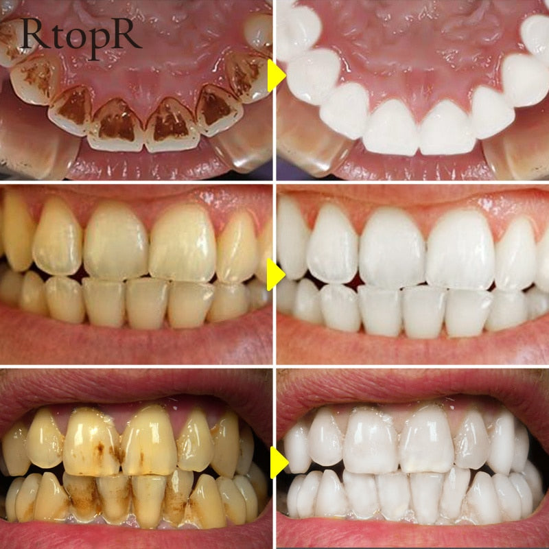 Clareador Dental RtopR - DUKSTORAGE